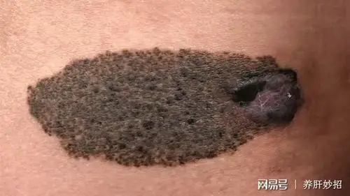 脸上长出6毫米的"黑痣",医院查出肝癌!这下连后悔药都没得吃