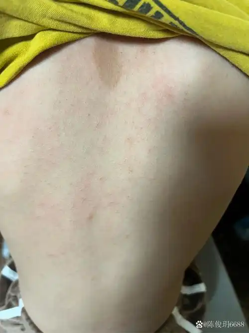 小朋友背上起了很多很多红疙瘩,摸上去很硌手,很痒,不知道是什么皮肤