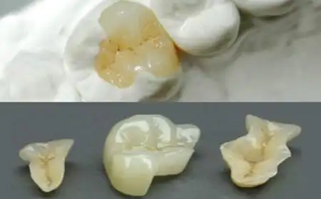 嵌体补牙vs普通补牙,哪种修复方法好 - 补牙 - 苏州牙博士口腔连锁【