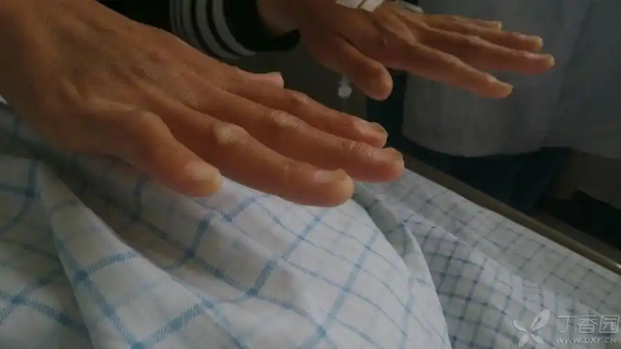 缺铁性贫血的反甲