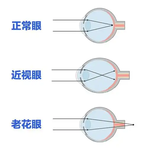 近视老花无法抵消中老年视力问题如何解决