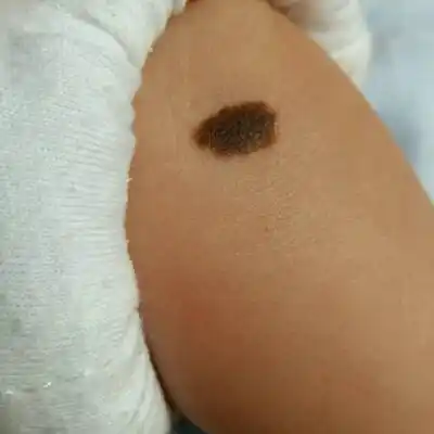 有宝妈听说过黑色素瘤吗?看看这个是吗?担心!_宝宝树