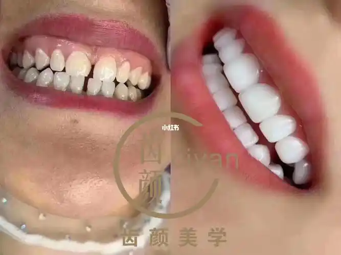 缝隙牙修复案例(好莱坞白)_好莱坞怎么样_牙套_全瓷贴面_美妆_医美