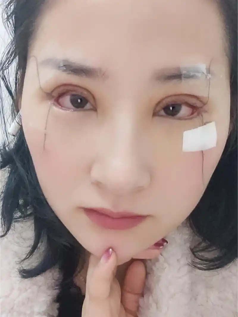 眼综合的第五天,现在还是很肿呀!