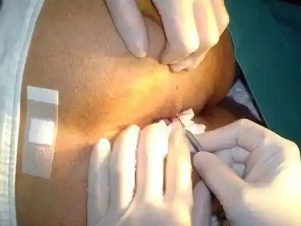 肛裂的最佳治疗方法(肛裂涂什么药膏能愈合) 肛裂的最佳治疗方法 第1