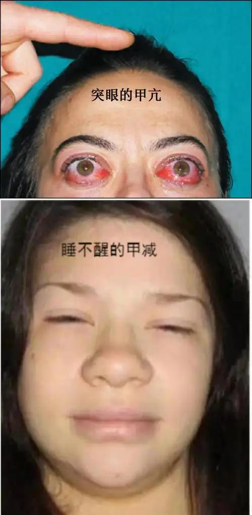 甲亢和甲减,别再傻傻分不清