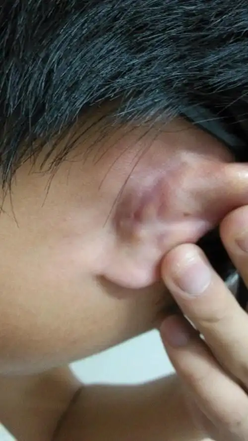 耳朵后面疼什么原因?耳根软骨处,有点发红的部分