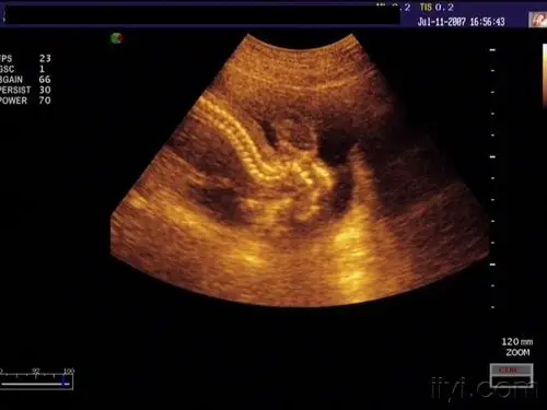 无脑儿 - 超声医学讨论版 - 爱爱医医学论坛