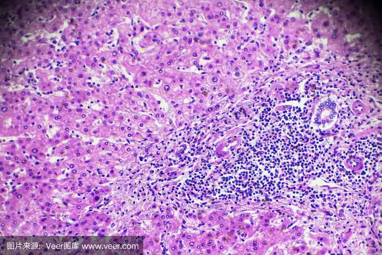 肝细胞癌,显微镜下的hcc