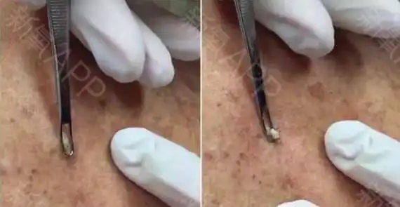 白头粉刺:角栓堵在毛囊口,皮脂排不出去.