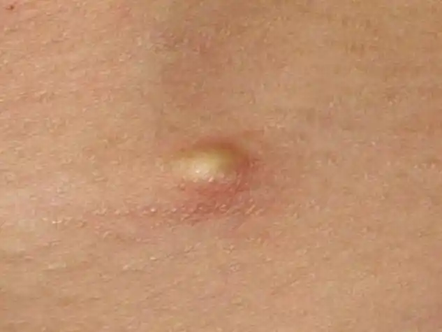 耳朵后边的皮脂腺囊肿图片