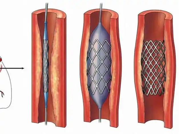 但心脏支架是一种"治标不治本"的治疗方式,血管堵塞的源头——动脉