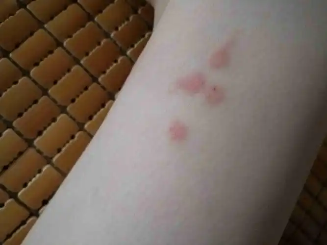 被蚊子咬了,好几个红包包有点吓人