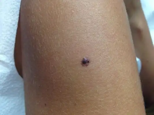 容易癌变的黑痣图片6