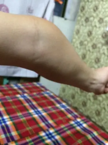 我的胳膊天生的弯曲有没有什么办法矫正过来?夏天都不敢伸直,自卑感