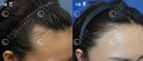 韩国布莱克女性发际线种植对比图