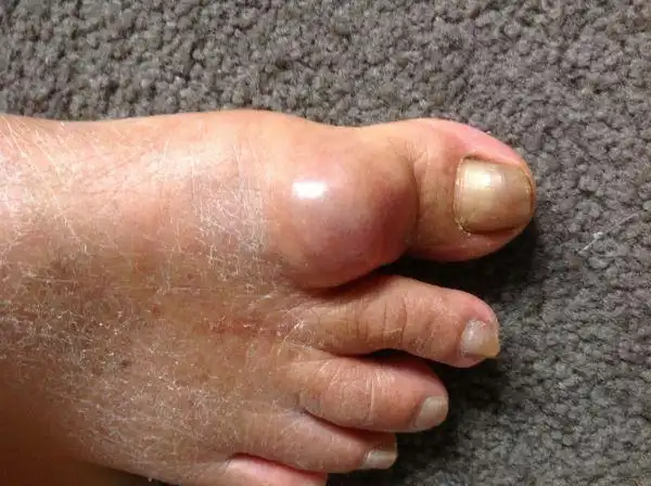 脚趾头下部长出一个无名肿毒瘤好了又会复法