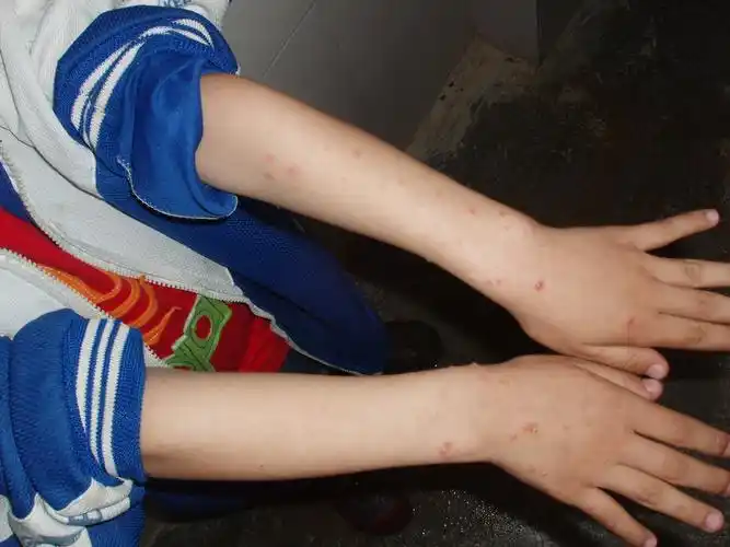 今天接诊的一例手足口病.