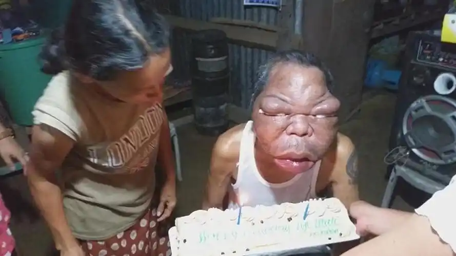 吓人!鼻窦炎不断恶化,菲律宾男子面肿四倍五官变形