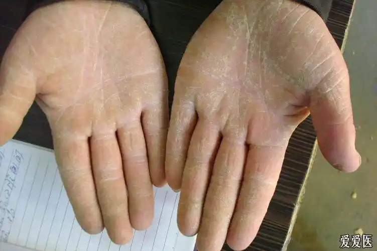 看图诊断43角化型湿疹