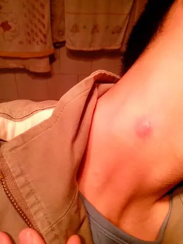 颈部淋巴结肿大,好几天了一开始起个小疖子样的东西周围红肿火辣辣挺