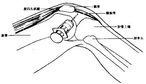 南皮县人民医院肾内风湿科关节腔穿刺术