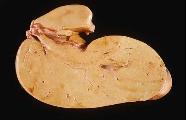 体检发现脂肪肝怎么办?告诉你一个极简的缓解办法!