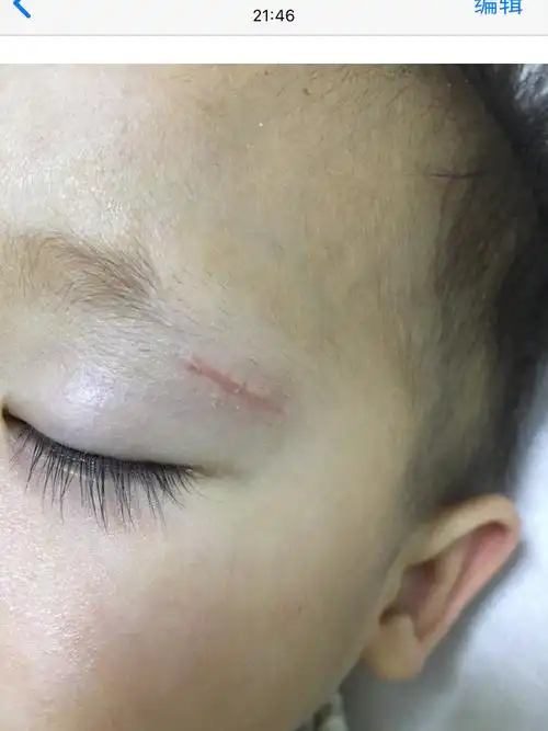 眼角磕伤第26天