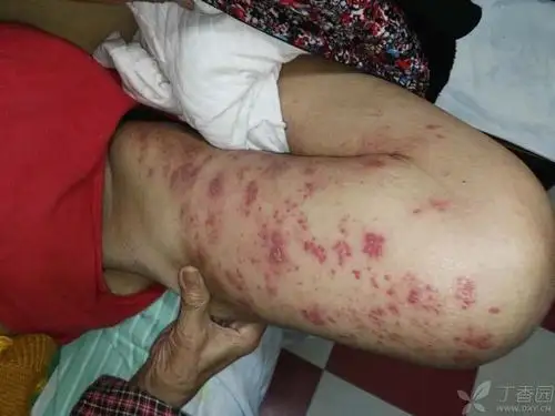 21:28   关注      本人家中老人,换肺癌许久,近期长了这些红色的类似