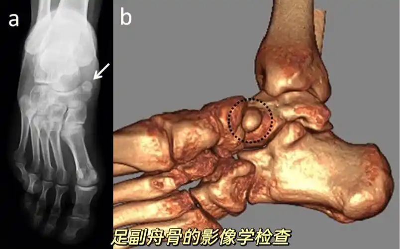 还在被副舟骨困扰么你的足副舟骨疼么