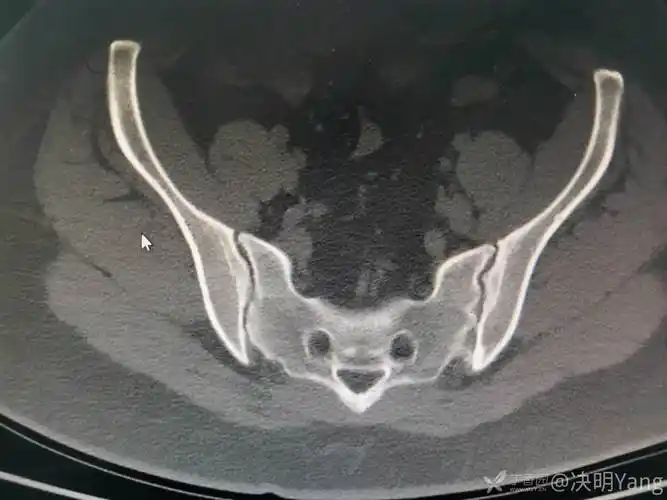 各位老师基层医院经验有限烦请各位可否指教这几张骶髂关节ct图像