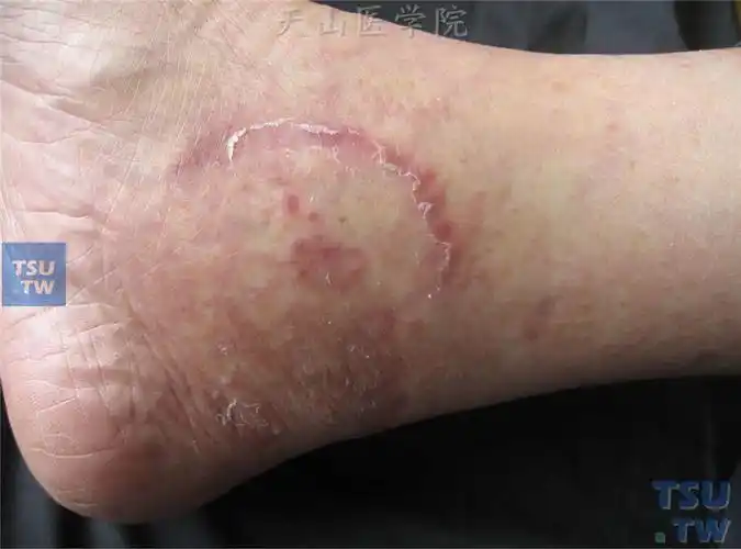 体癣(tinea corporis)的症状表现
