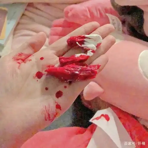 鼻出血应该怎么处理,不要盲目乱塞