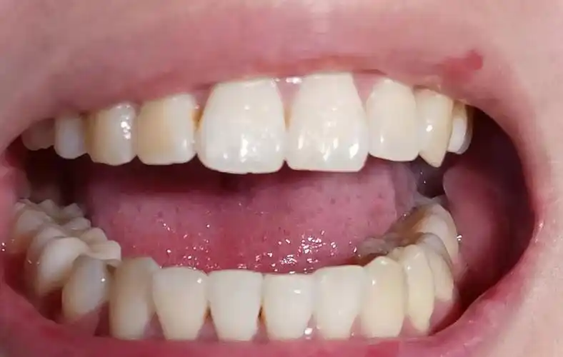 牙龈好像萎缩了黑三角严重还有救吗