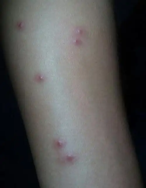 认识虫咬皮炎丘疹性荨麻疹