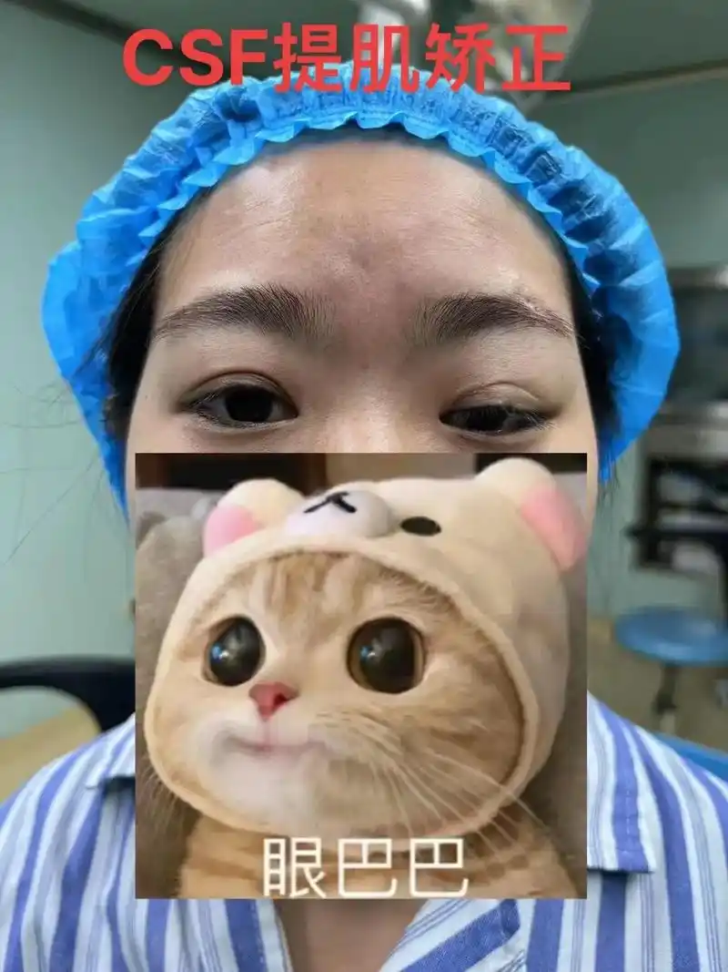 双眼皮 #现场实拍 修复型提肌无力好评[ - 抖音