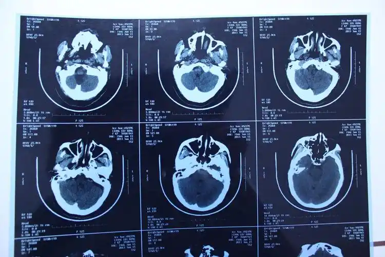 万能的百度,有没有医生,帮忙看看ct片子,重谢