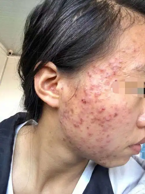 青春痘,就要及早处理及早改善,想要减少痘痘就要自律一些,并且及用