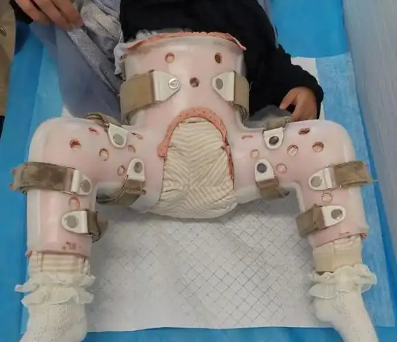 髋关节已逐渐复位,但髋臼发育还是不如正常孩子,需要继续穿支具治疗