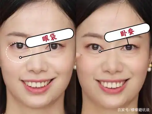 眼部审美|你适合哪种卧蚕?