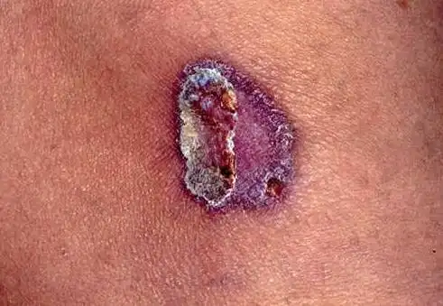 扁平苔藓的症状是什么样的(5)