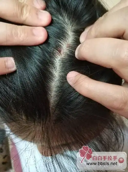 大家看看头皮上是牛皮癣吗?