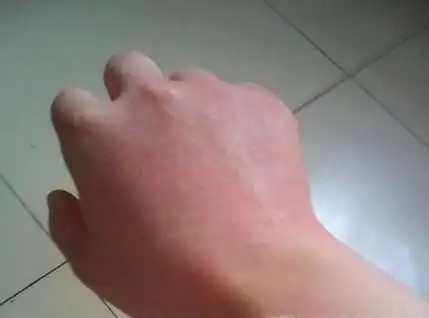 手背上红点红斑是什么东西这有问题吗