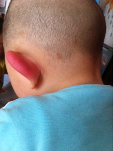 宝贝的耳朵怎么啦 好红 还有点肿