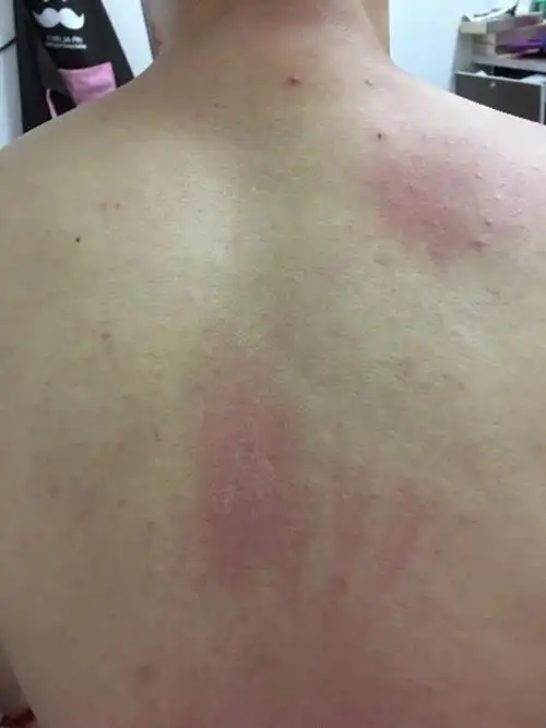 背上很痒,一抓起一片红疙瘩,用了一个礼拜的复方