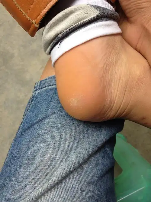 脚跟底部不知道是长了什么,像是茧子一样有点硬,走路痛,我用刀子割了
