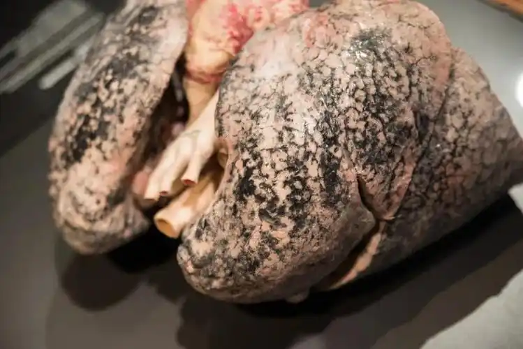 吸烟者的肺图片(戒烟后) - 赤虎壹号