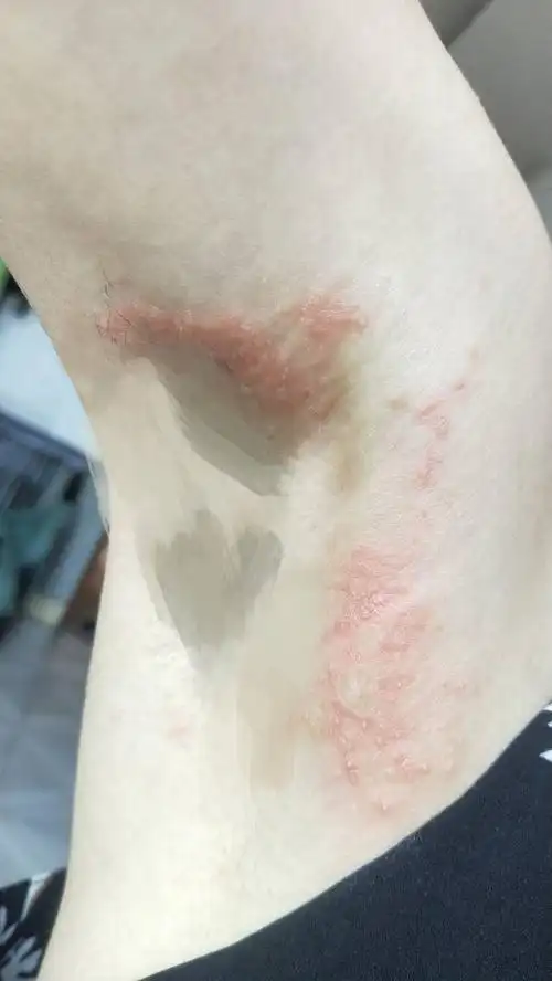 请问腋下长的是什么疹?该怎么处理用药?
