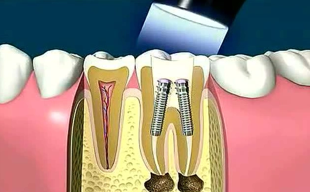 千能解决的事了)毕竟根管治疗(就是你们说的"杀神经")是经过历史检验
