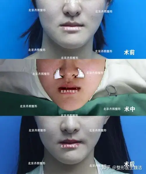 鼻基底凹陷填充对比照片加强型膨体垫鼻翼基底